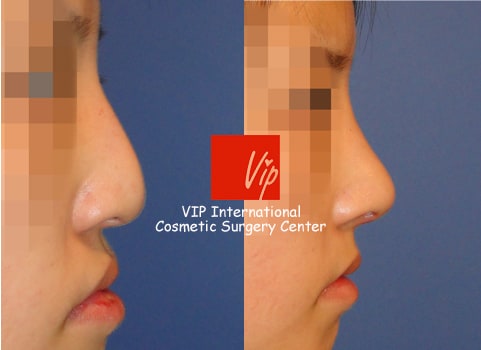 Nose Surgery, Facial Bone Surgery - Humped nose correction (protruded mouth improvement as well)- Rib cartilage rhinoplasty