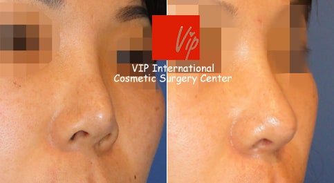 	Harmony-Rhinoplasty, Rib cartilage Rhinoplasty, Revision Rhinoplasty	 - Upturned nose due to silicone - Revision surgery