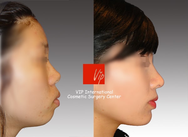 	Harmony-Rhinoplasty, Protruded Mouth Correction Rhinoplasty, Rib cartilage Rhinoplasty	 - VIP Harmony rhinoplasty ( small, upturned & protruded mouth correction )