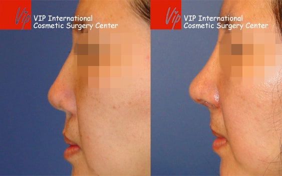 	Nose Surgery, Rib cartilage Rhinoplasty, Each Cases Nose	 - Cleft lip correction - Rib cartilage rhinoplasty
