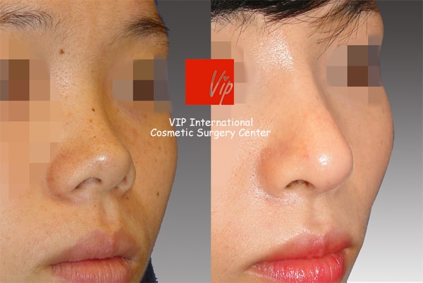 	Harmony-Rhinoplasty, Protruded Mouth Correction Rhinoplasty, Rib cartilage Rhinoplasty	 - VIP Harmony rhinoplasty ( small, upturned & protruded mouth correction )