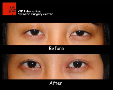 Eye Surgery - Ptosis correction