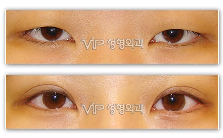 Eye Surgery - Upper & Lower blepharoplasty