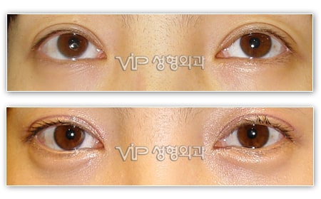 Eye Surgery - Smiley eyes surgery