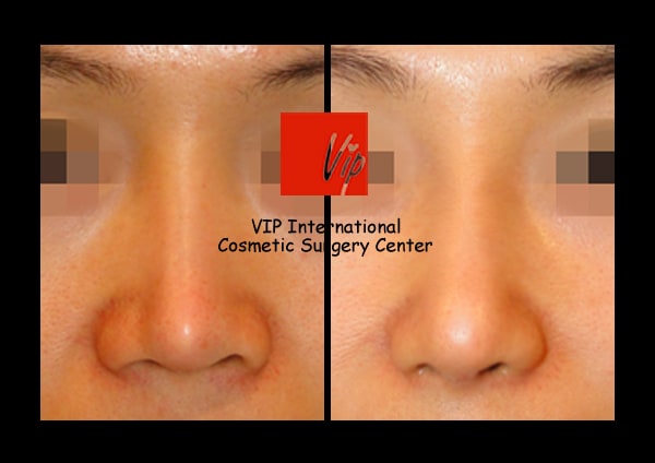 	Nose Surgery, Rib cartilage Rhinoplasty, Each Cases Nose	 - Revision of silicone showing nose - Rib cartilage rhinoplasty