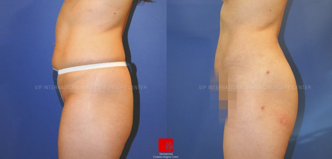 	Fat graft, Body Contouring	 - Buttocks augmentation with fat graft