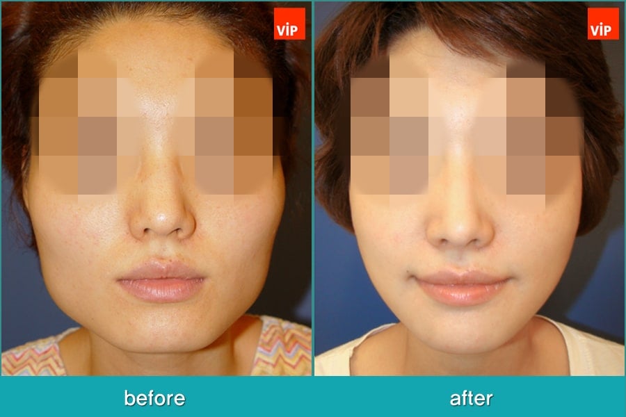 	Nose Surgery, Septal Deviation, Facial Bone Surgery	 - Septal Cartilage Rhinoplasty, Face Contouring Surgery, V-line Surgery, Cheekbone Reduction