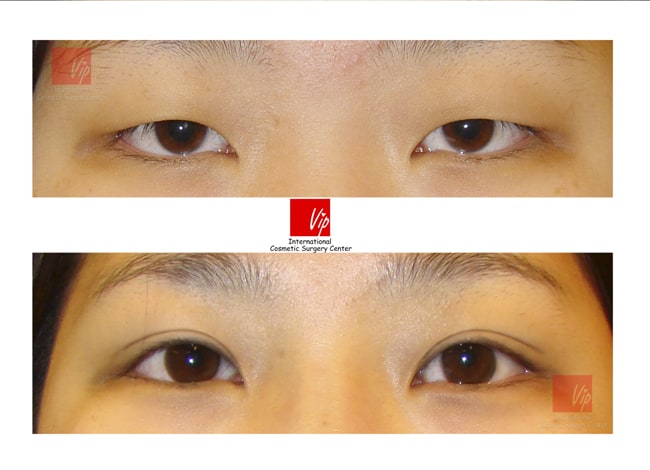 	Ptosis Correction, Epicanthoplasty	 - Sleepy eyes-Ptosis correction