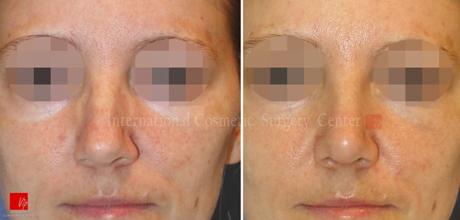 	Nose Surgery, Harmony-Rhinoplasty, Each Cases Nose	 - Septal deviation, humped nose correction