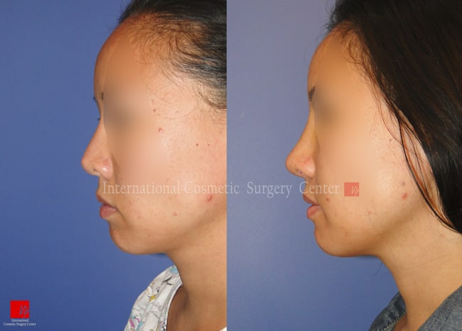 	Nose Surgery, Harmony-Rhinoplasty, Rib cartilage Rhinoplasty, Revision Rhinoplasty, Septal Deviation	 - Foreign implant showing & deviation