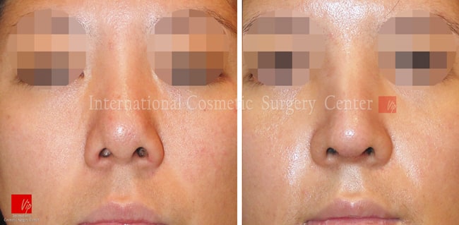 	Nose Surgery, Revision Rhinoplasty, Each Cases Nose	 - Remove foreign implant & autologous rhinoplasty