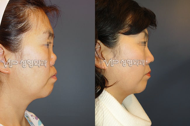 	Protruded Mouth Correction Rhinoplasty, Rib cartilage Rhinoplasty, Contracted Nose, Revision Rhinoplasty, Each Cases Nose	 - Revision rhinoplasty with Rib cartilage -Collapsed by silicone implant