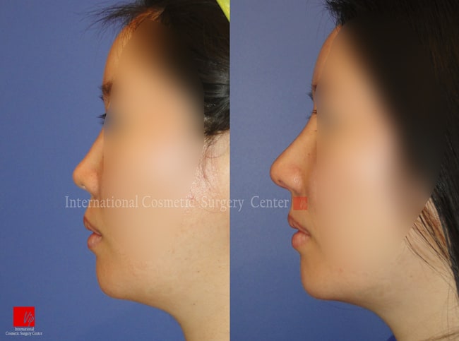 	Harmony-Rhinoplasty, Protruded Mouth Correction Rhinoplasty, Revision Rhinoplasty, Septal Deviation	 - Small nose with Septal deviation