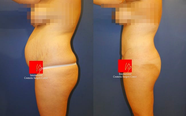 	Body Contouring	 - Abdominal surgery with liposuction