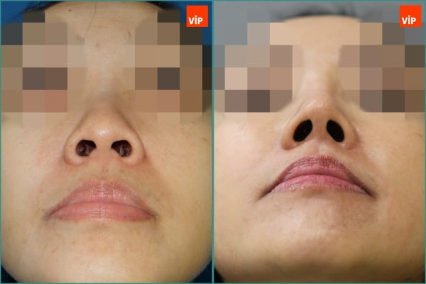 Nose Surgery, Fat graft - Combination Rhinoplasty, Fat Graft