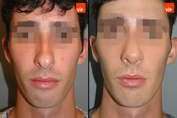 Nose Surgery - Septal Cartilage Rhinoplasty