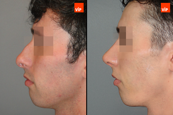 Nose Surgery - Septal Cartilage Rhinoplasty