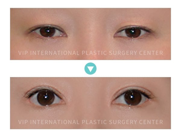 Eye Surgery - Double Eyelid Surgery