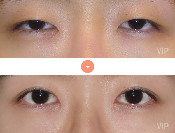 Eye Surgery - Double Eyelid Surgery