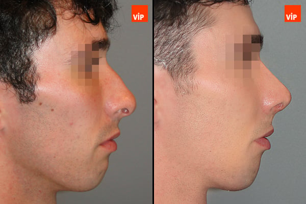 Nose Surgery - Septal Cartilage Rhinoplasty