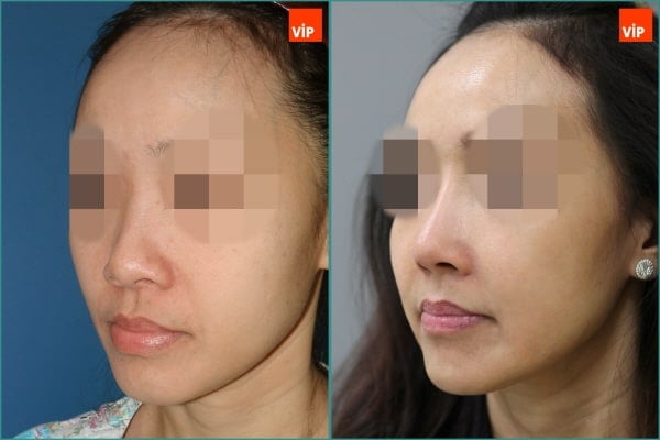 Nose Surgery, Fat graft - Combination Rhinoplasty, Fat Graft