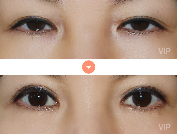 Eye Surgery - Double eyelid surgery