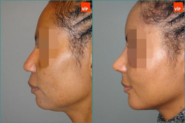 Nose Surgery - Rib cartilage rhinoplasty