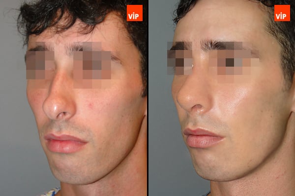 Nose Surgery - Septal Cartilage Rhinoplasty