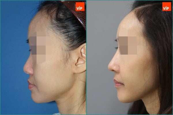 Nose Surgery, Fat graft - Combination Rhinoplasty, Fat Graft