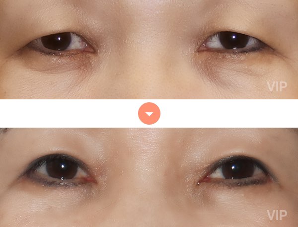 Eye Surgery - Double Eyelid Surgery