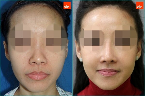 Nose Surgery, Fat graft - Combination Rhinoplasty, Fat Graft