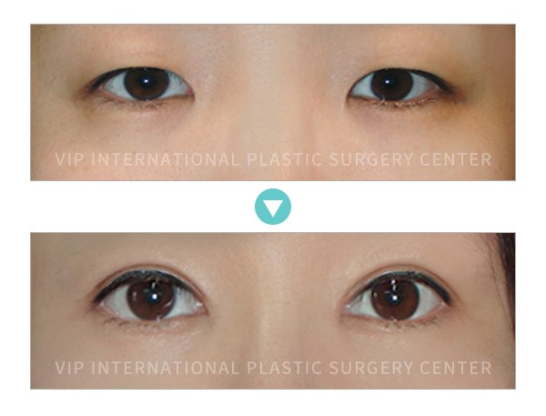 Eye Surgery - double eyelid surgery