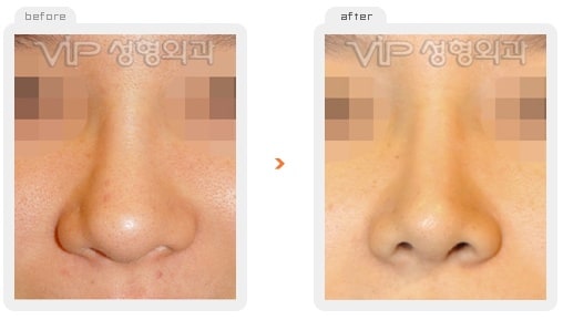 	Nose Surgery, Rib cartilage Rhinoplasty	 - Rib cartilage rhinoplasty