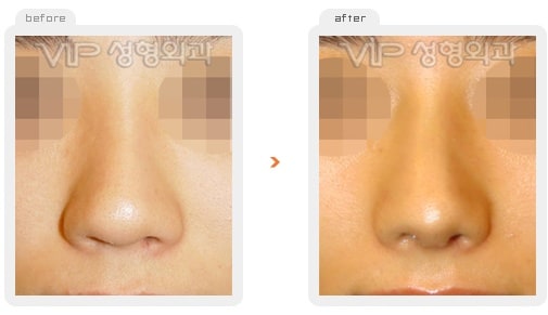 	Nose Surgery, Rib cartilage Rhinoplasty	 - Rib cartilage rhinoplasty