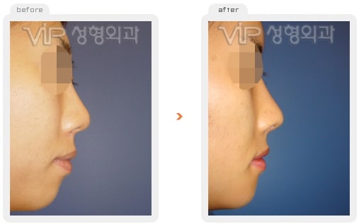 	Nose Surgery, Rib cartilage Rhinoplasty	 - Rib cartilage rhinoplasty