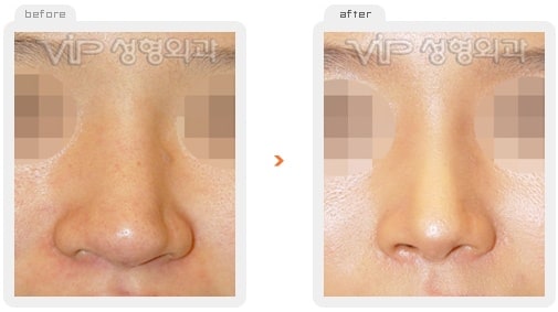 	Nose Surgery, Rib cartilage Rhinoplasty	 - Rib cartilage rhinoplasty