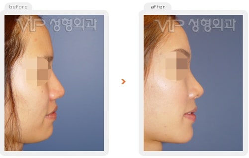 	Nose Surgery, Rib cartilage Rhinoplasty	 - Rib cartilage rhinoplasty