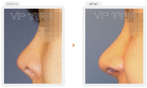 	Nose Surgery, Rib cartilage Rhinoplasty	 - Rib cartilage rhinoplasty