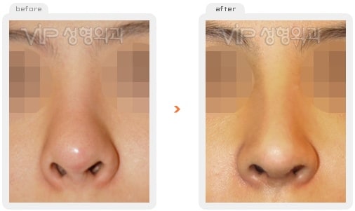 	Nose Surgery, Rib cartilage Rhinoplasty	 - Rib cartilage rhinoplasty