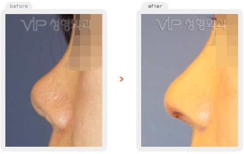Nose Surgery - Revision rhinoplasty
