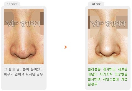 Nose Surgery - Revision rhinoplasty - Silicone/ear cartilage showing nose
