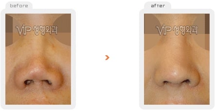 	Nose Surgery, Revision Rhinoplasty	 - Revision rhinoplasty - Upturned nose