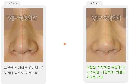Nose Surgery - Revision rhinoplasty - Droopy tip