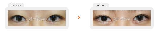 	Eye Surgery	 - Non-incision double eyelid surgery