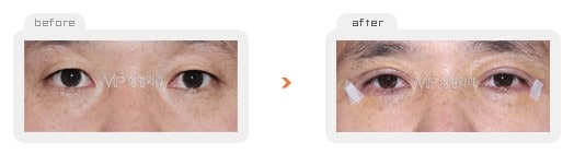 	Eye Surgery	 - Upper & Lower blepharoplasty