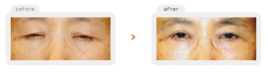 	Eye Surgery	 - Upper & Lower blepharoplasty