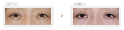 	Eye Surgery	 - Upper & Lower blepharoplasty