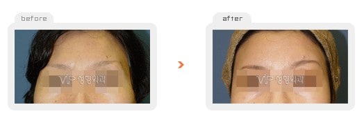 Fat graft - Fat graft - forehead & temple