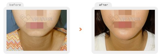 Fat graft - Fat graft - front chin