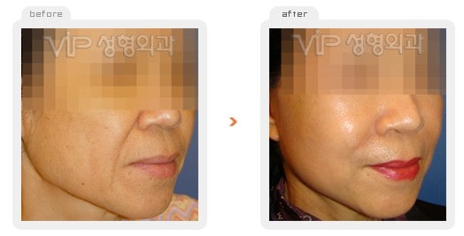 Face Lift - Wrinkle improvement surgery